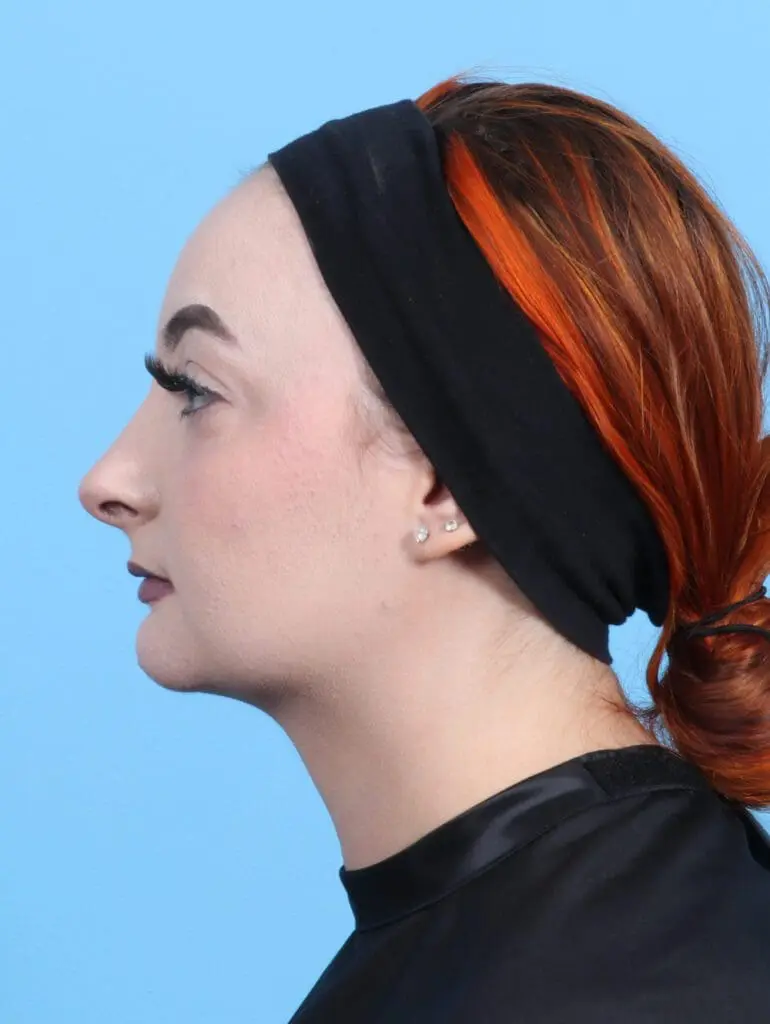 Chin Implant - Case 22346 - After