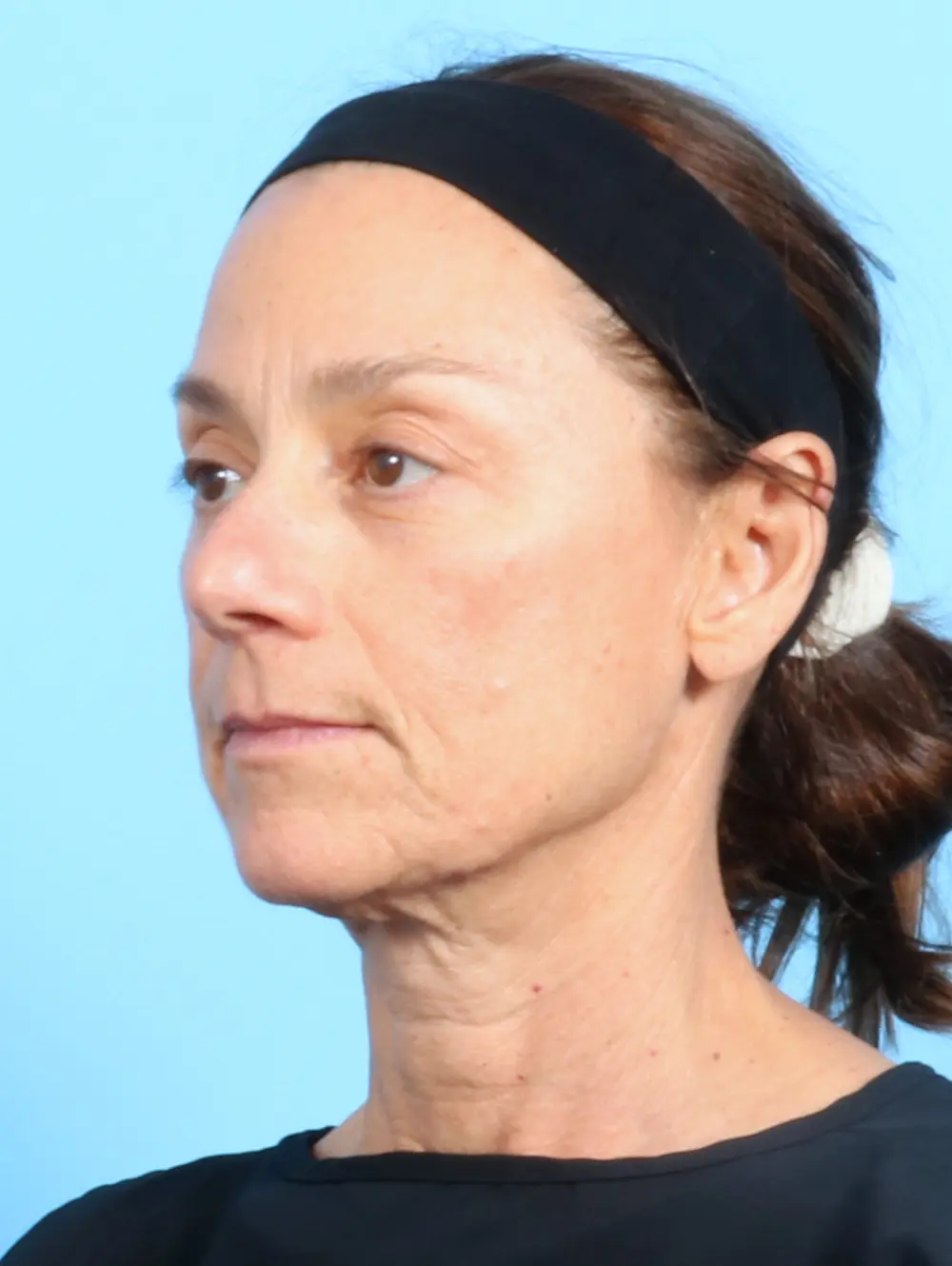 Eyelid Surgery Patient Photo - Case 22354 - before view-1