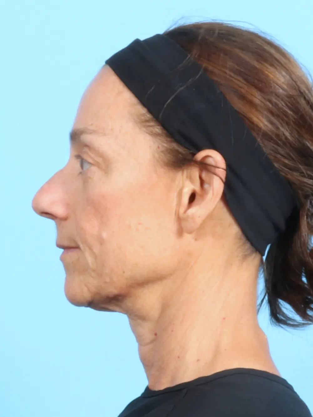 Eyelid Surgery Patient Photo - Case 22354 - before view-2