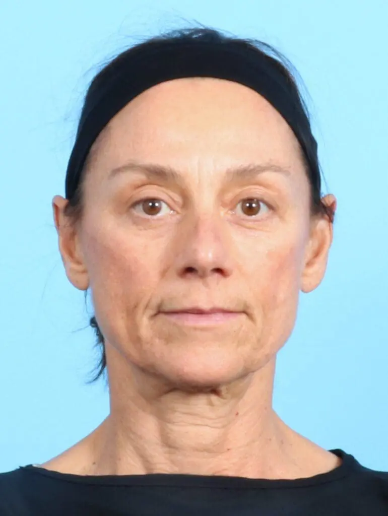 Eyelid Surgery - Case 22354 - Before