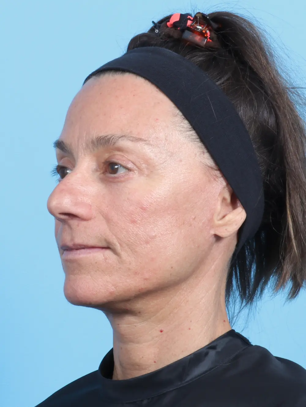 Eyelid Surgery Patient Photo - Case 22354 - after view-1