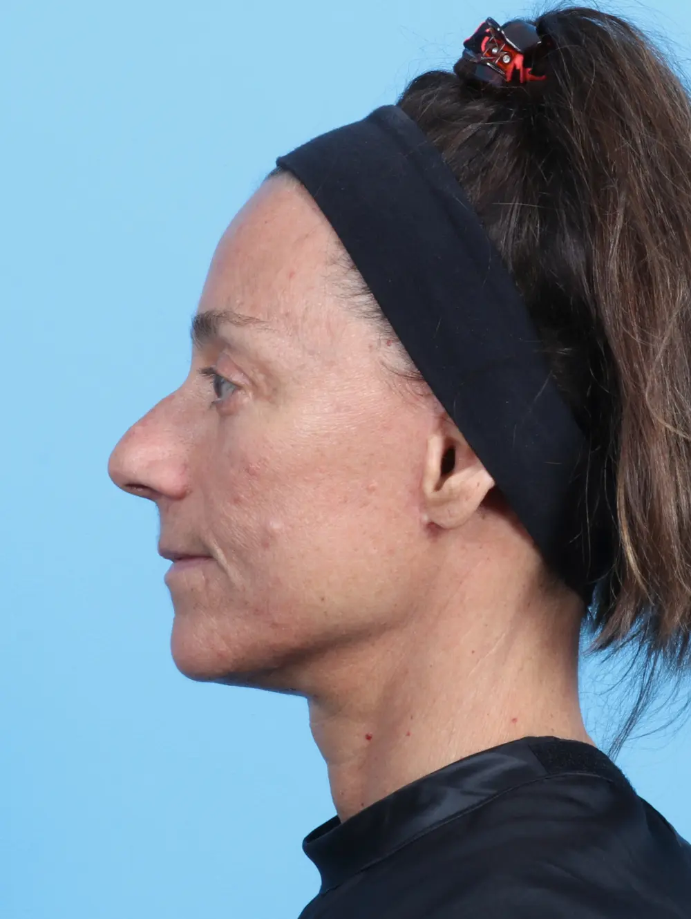 Eyelid Surgery Patient Photo - Case 22354 - after view-2