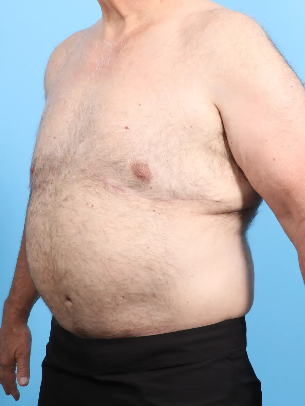 After Weight Loss Patient Photo - Case 22829 - after view-1