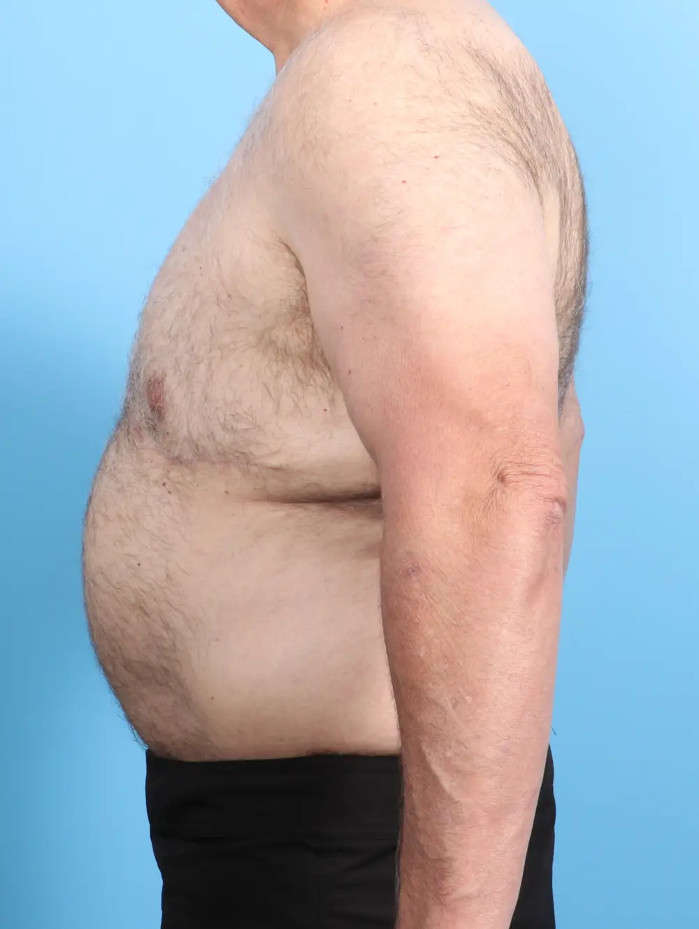 After Weight Loss Patient Photo - Case 22829 - after view-2