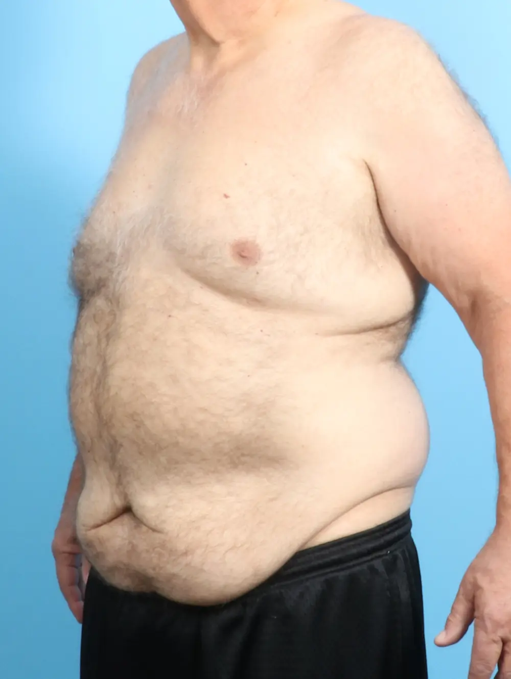 After Weight Loss Patient Photo - Case 22829 - before view-1