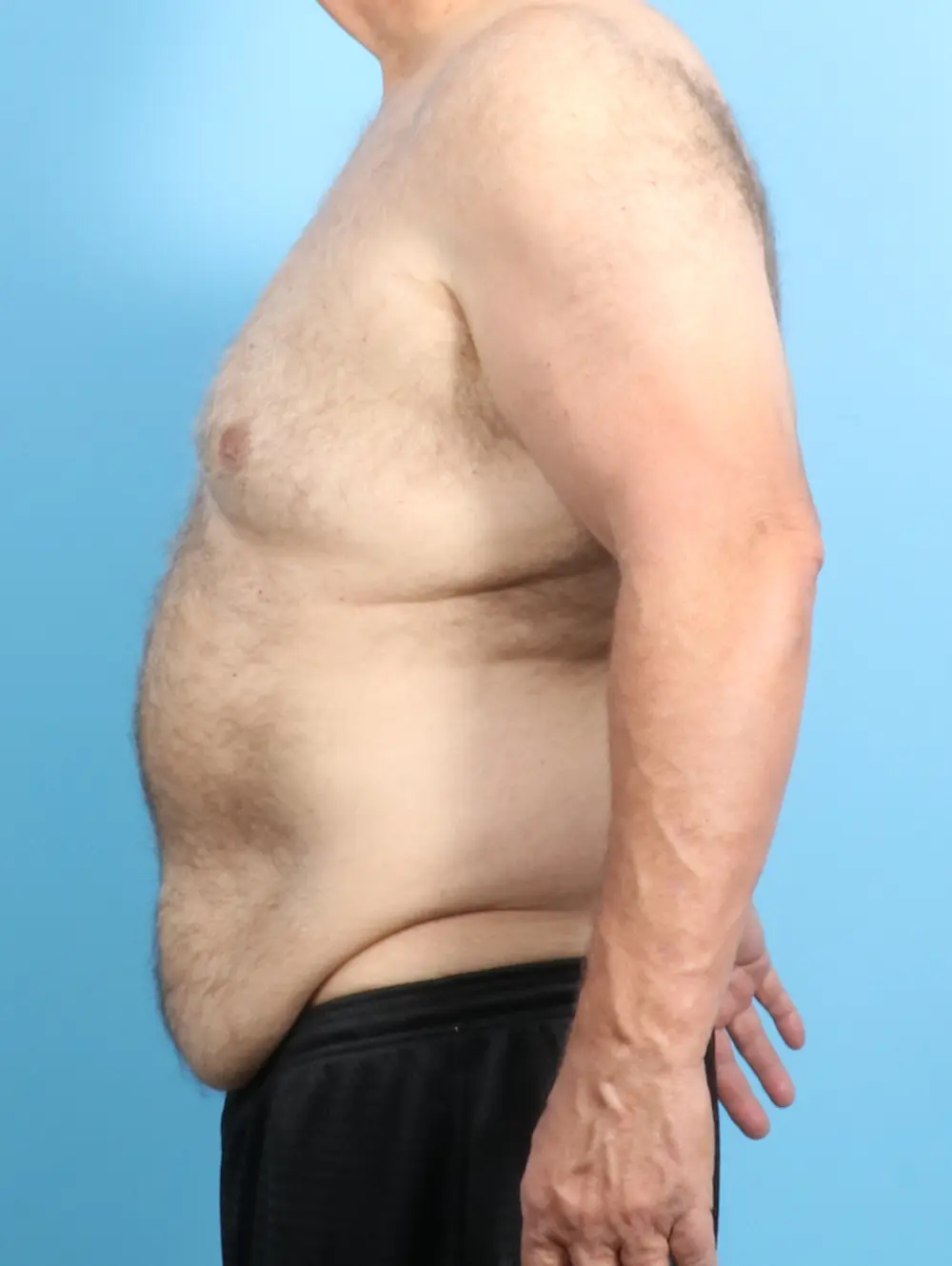 After Weight Loss Patient Photo - Case 22829 - before view-2