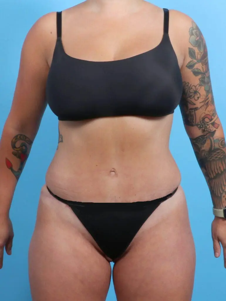 Tummy Tuck - Case 22963 - After