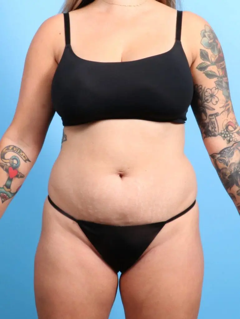 Tummy Tuck - Case 22963 - Before