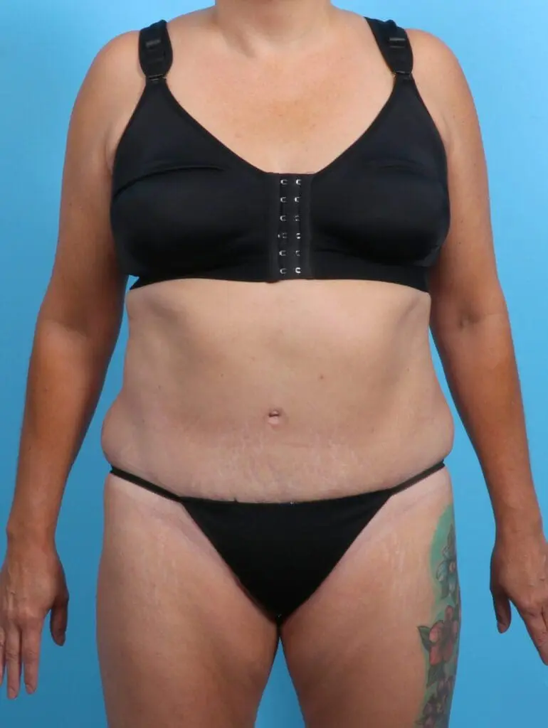 Tummy Tuck - Case 23007 - After