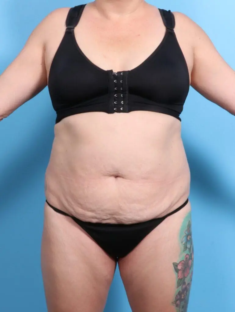 Tummy Tuck - Case 23007 - Before