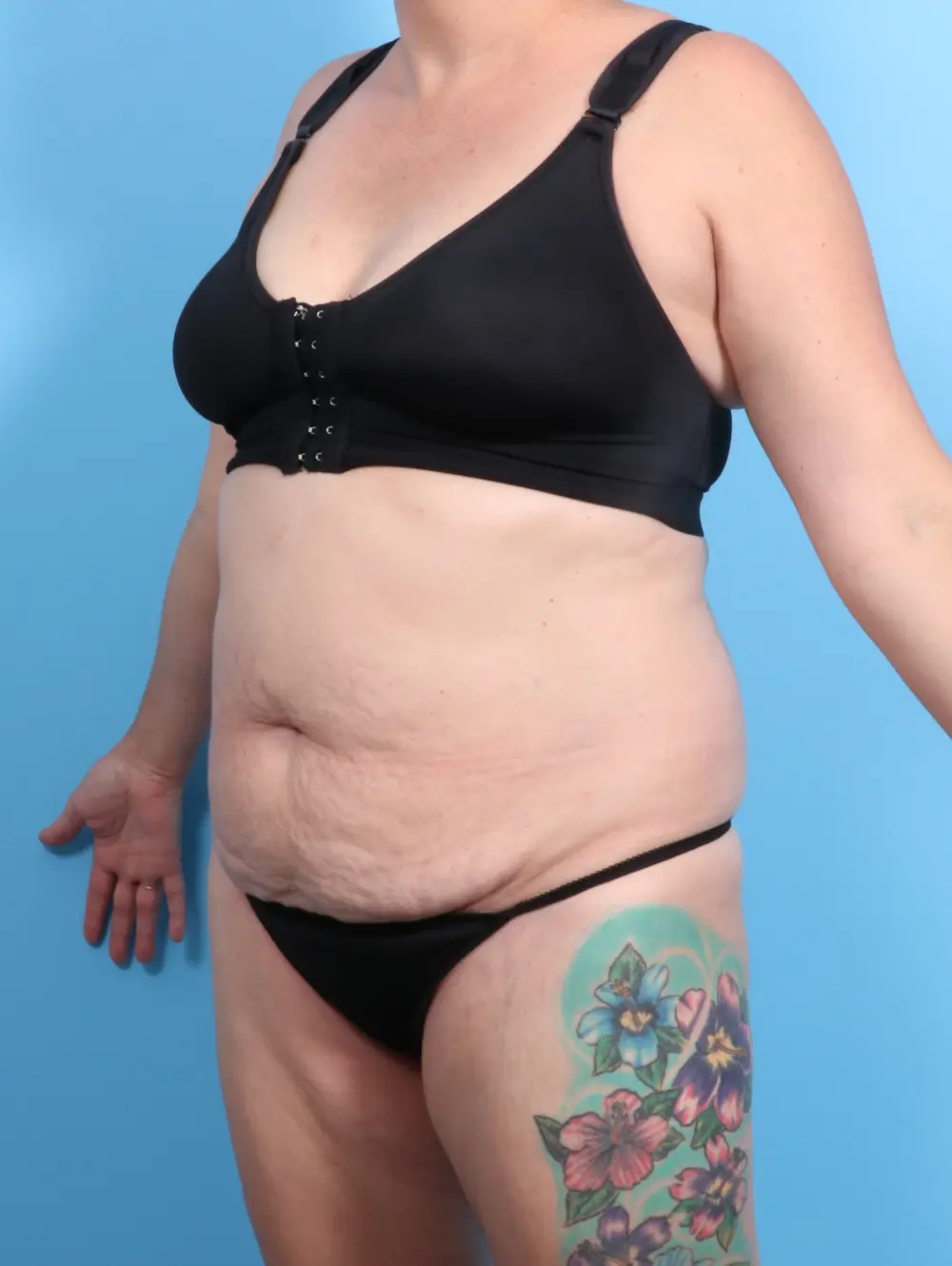 Tummy Tuck Patient Photo - Case 23007 - before view-1