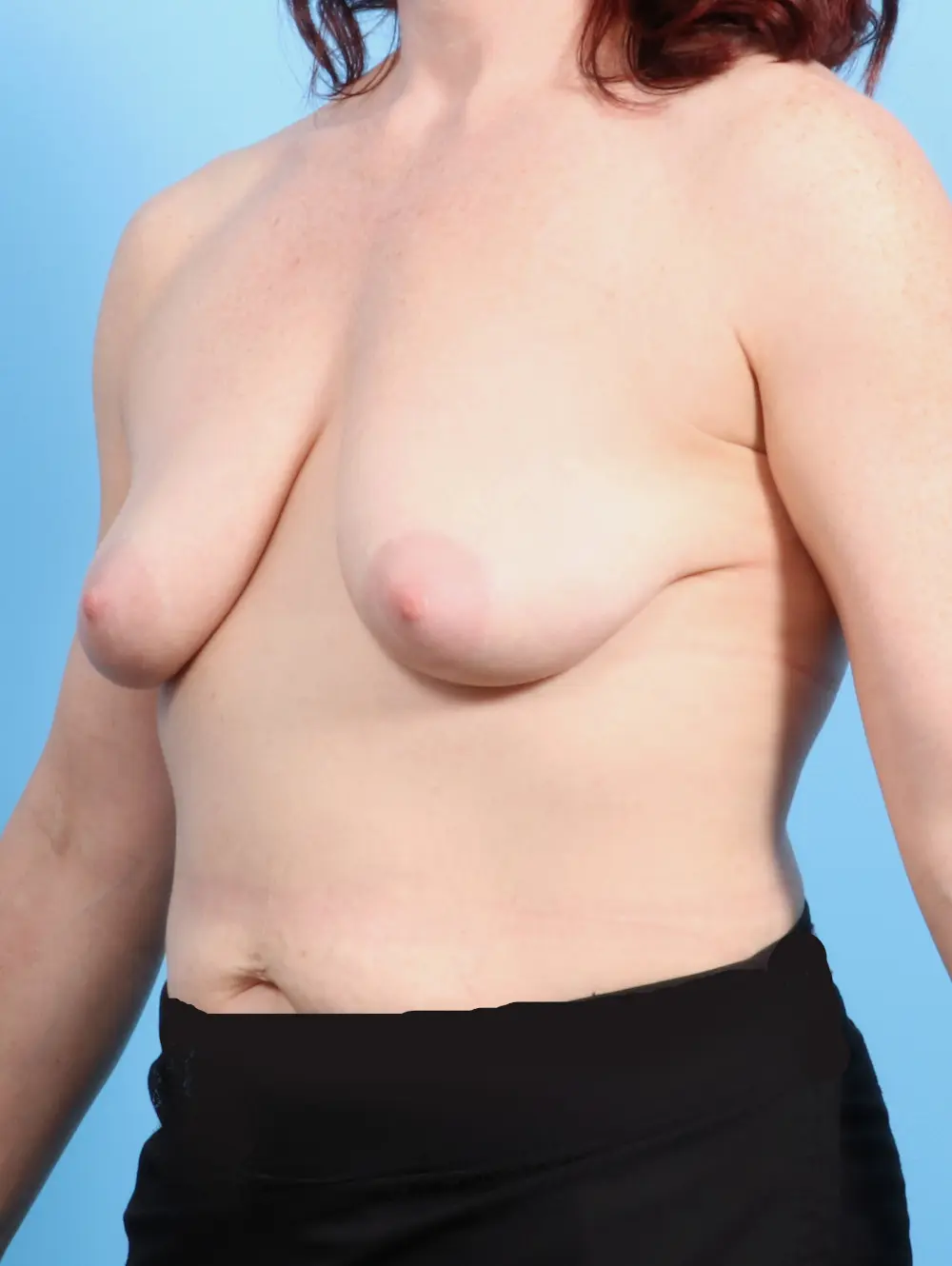 Breast Lift/Reduction with Implants Patient Photo - Case 23037 - before view-1