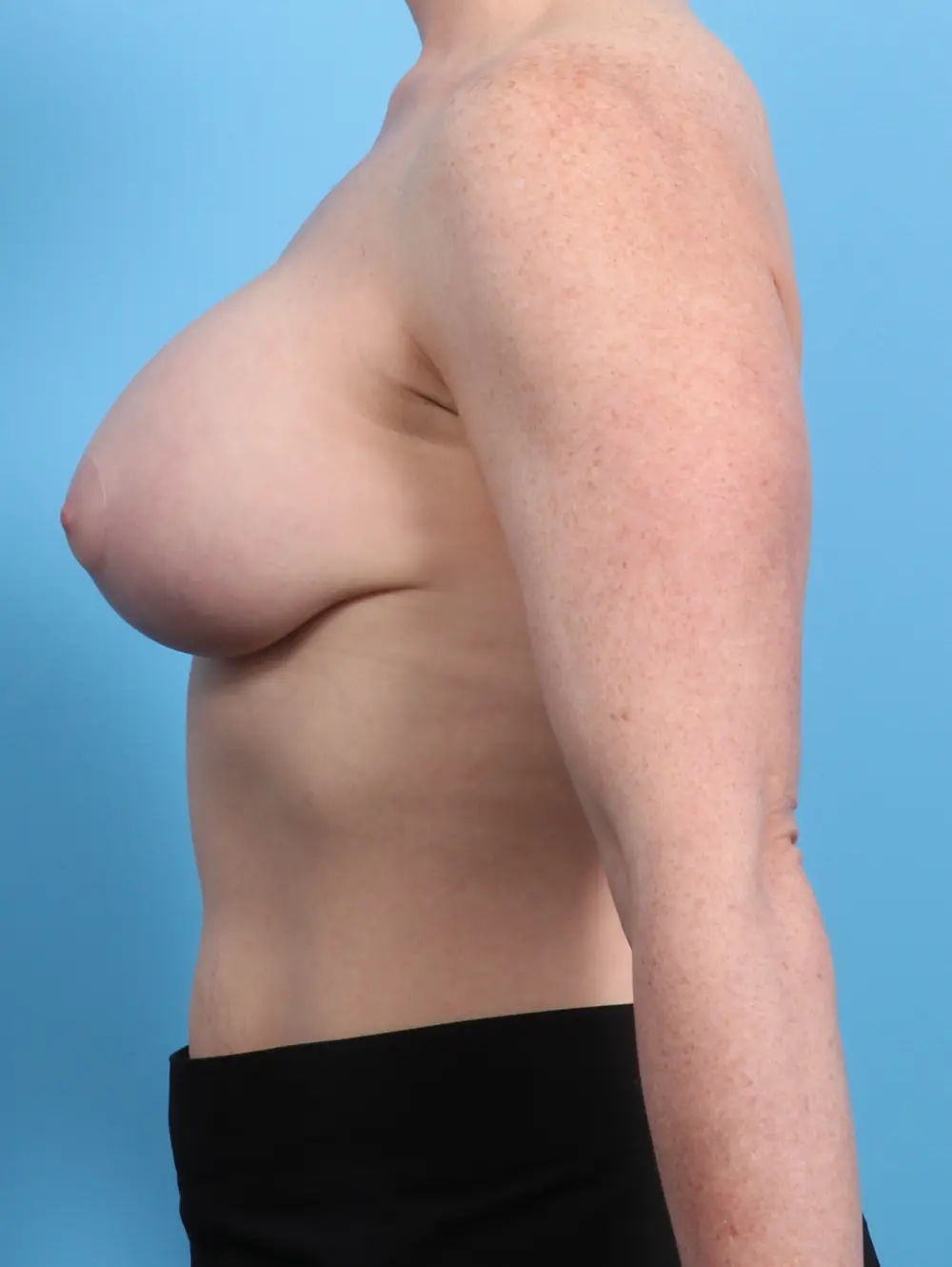 Breast Lift/Reduction with Implants Patient Photo - Case 23037 - after view-2