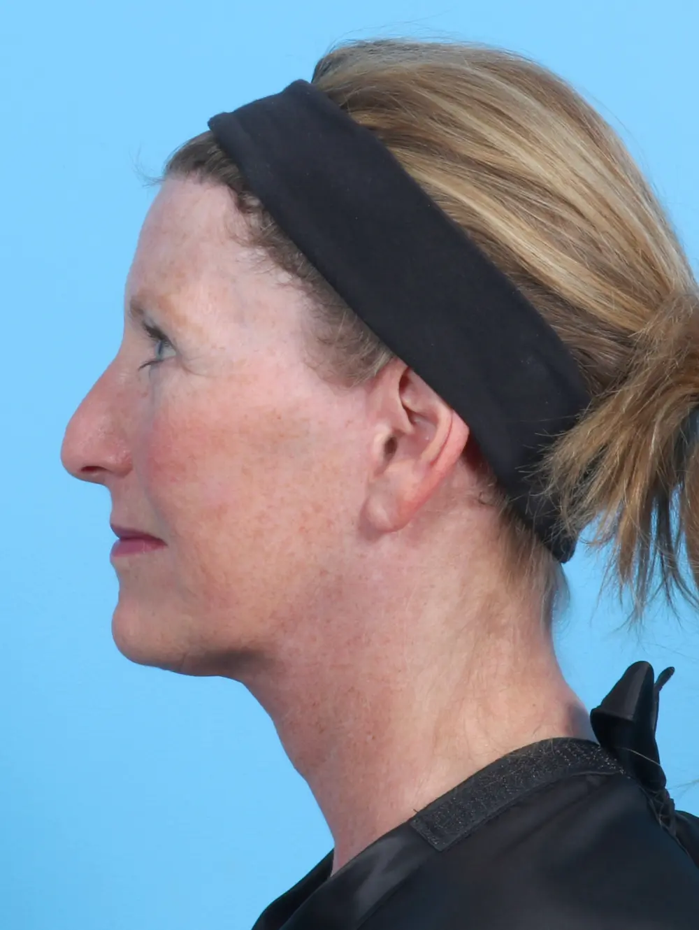 Brow Lift Patient Photo - Case 23047 - after view-2