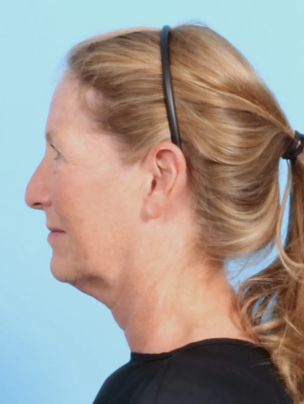 Brow Lift Patient Photo - Case 23047 - before view-2
