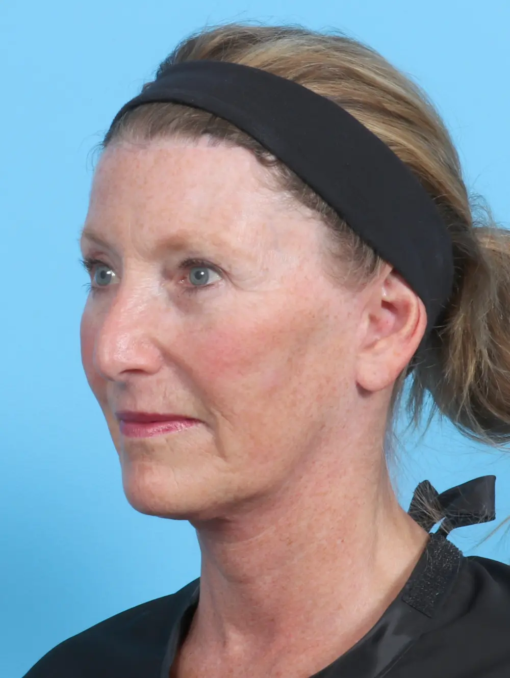 Brow Lift Patient Photo - Case 23047 - after view-1