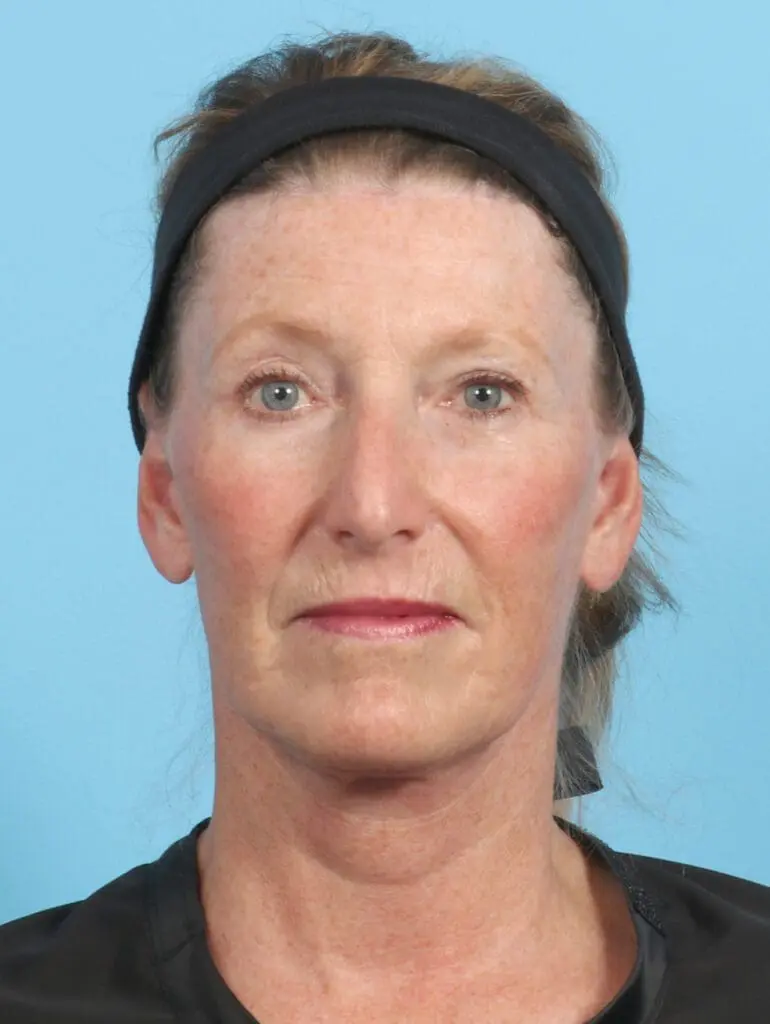 Brow Lift - Case 23047 - After