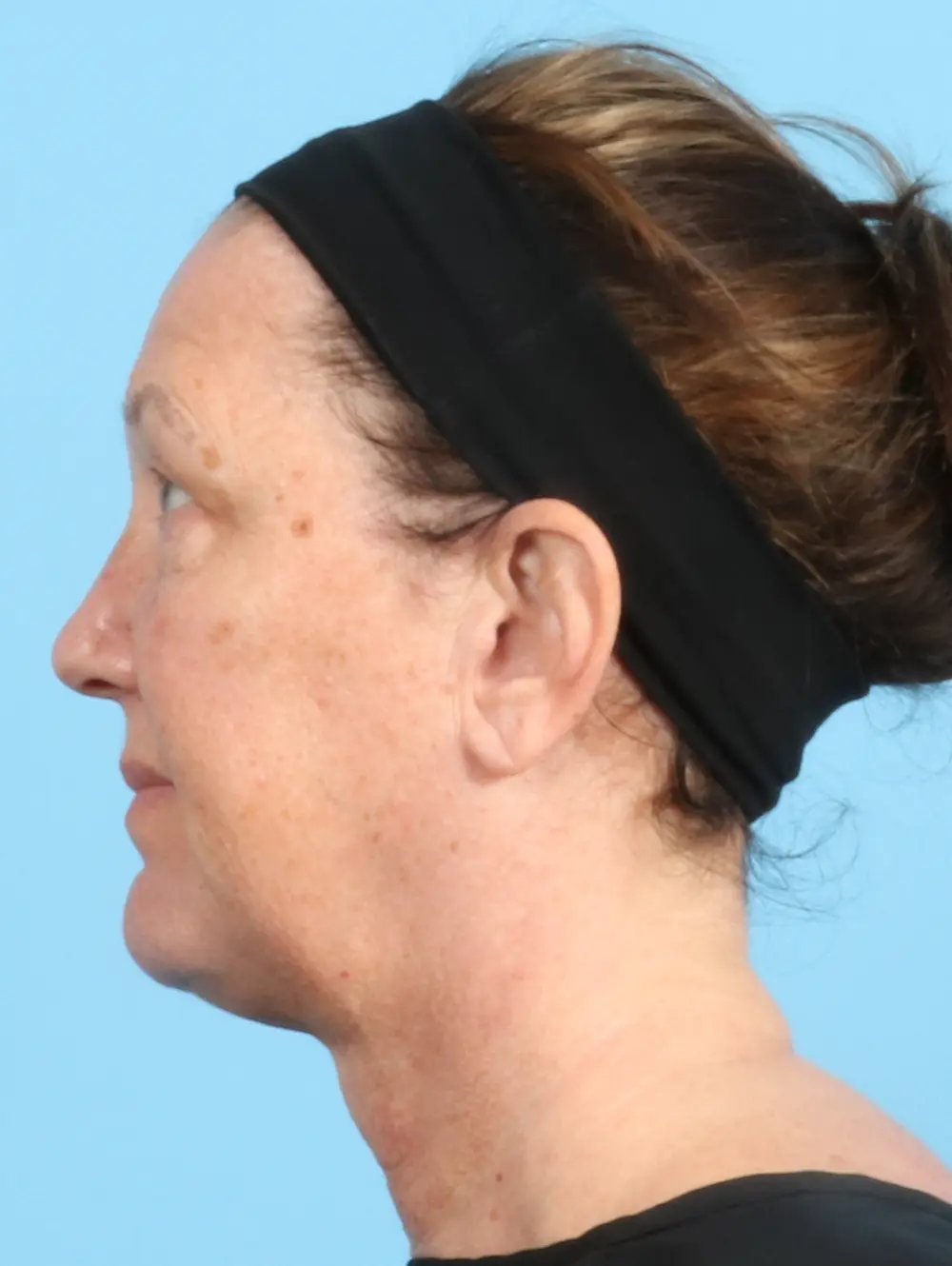 Eyelid Surgery Patient Photo - Case 23065 - before view-2