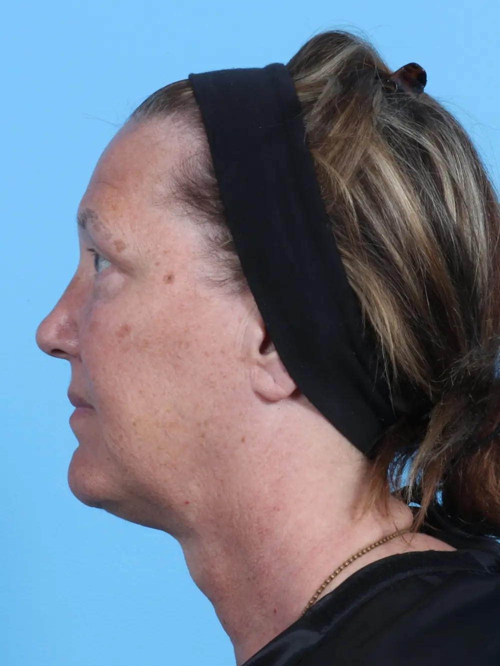 Eyelid Surgery Patient Photo - Case 23065 - after view-2