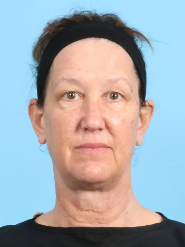 Eyelid Surgery - Case 23065 - Before