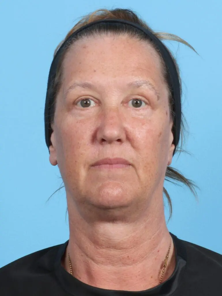 Eyelid Surgery - Case 23065 - After