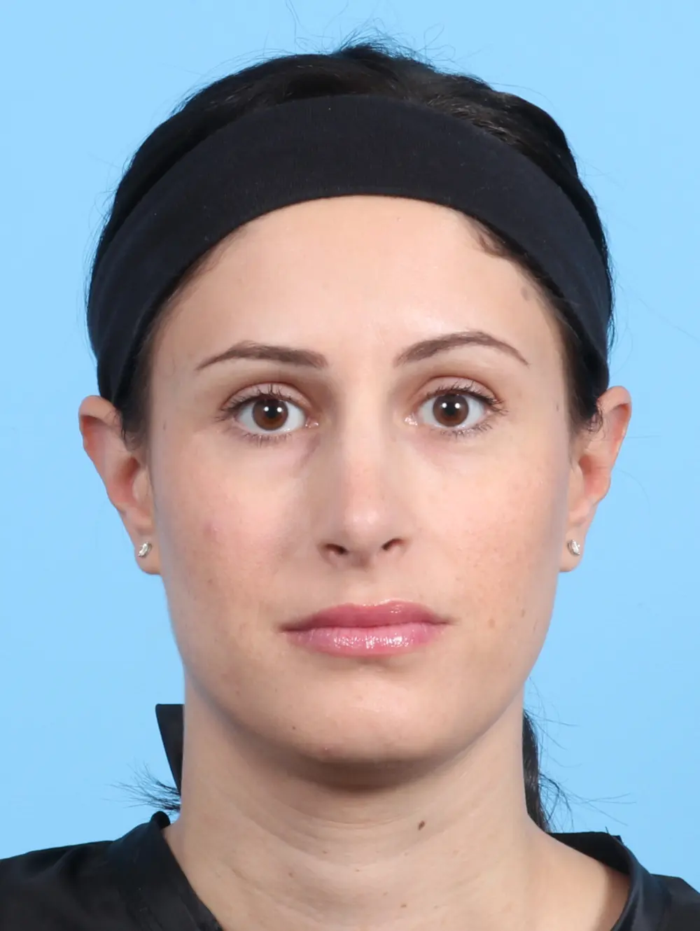 Rhinoplasty Patient Photo - Case 23073 - after view-1