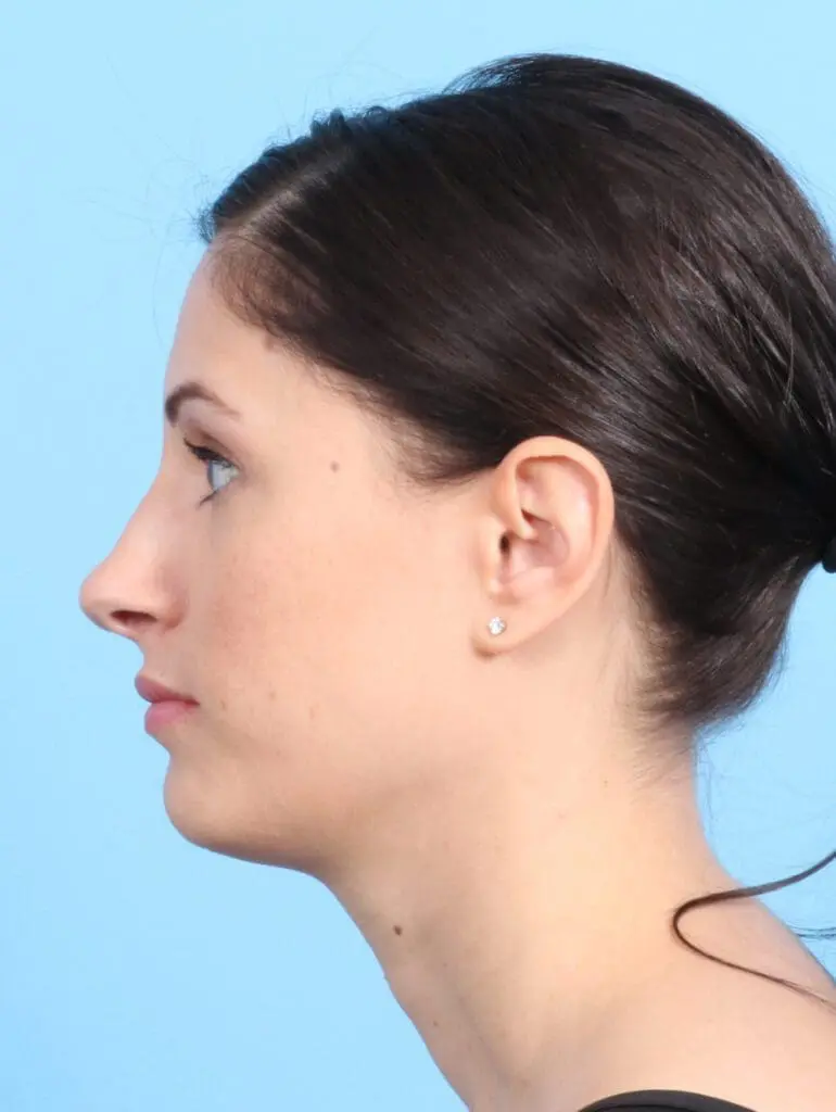 Rhinoplasty - Case 23073 - Before