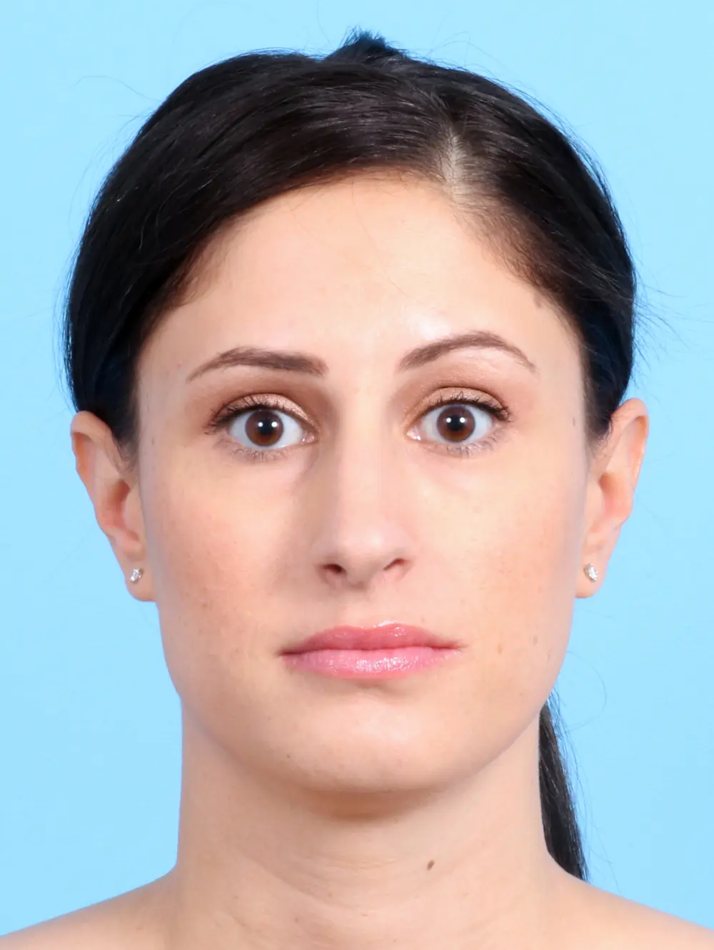 Rhinoplasty Patient Photo - Case 23073 - before view-1
