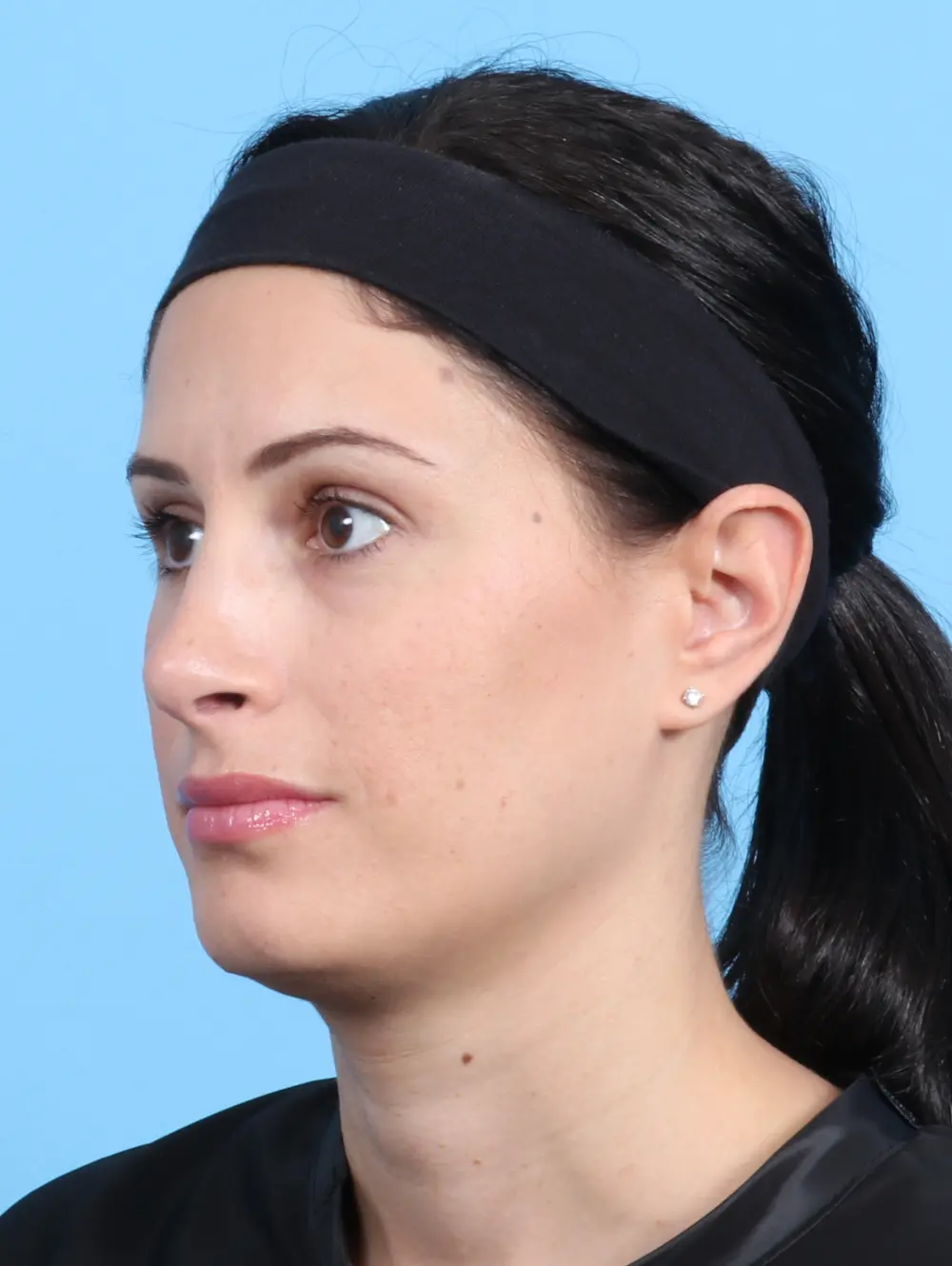 Rhinoplasty Patient Photo - Case 23073 - after view-2