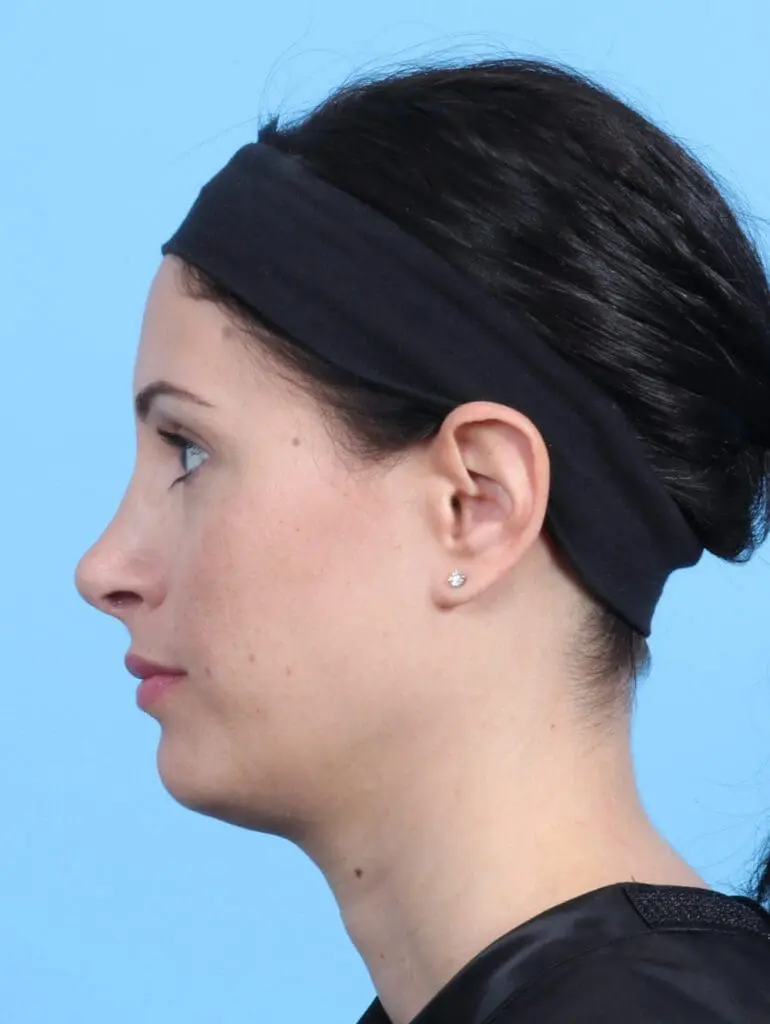 Rhinoplasty - Case 23073 - After
