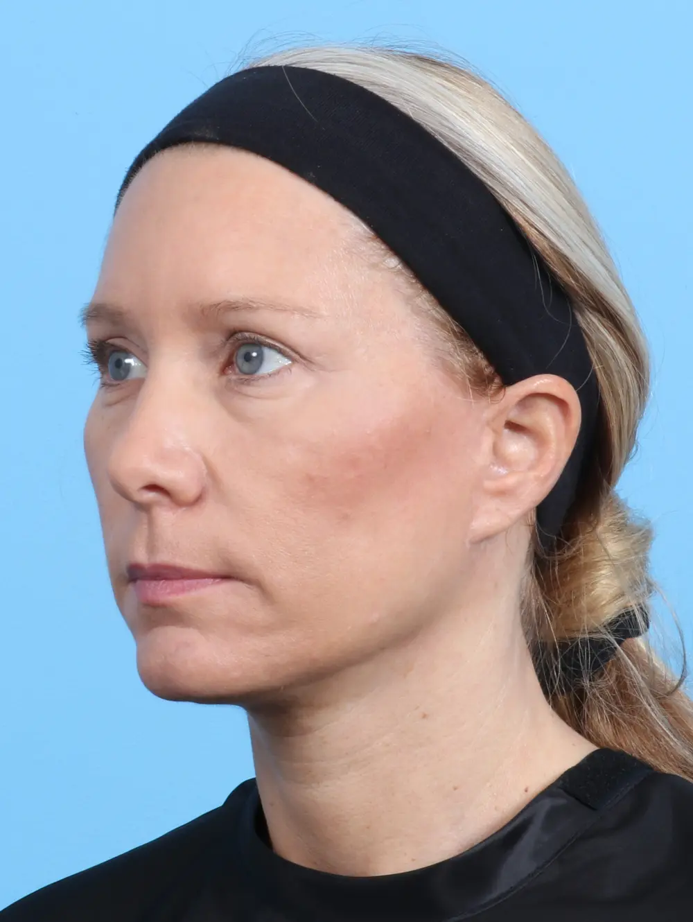 Eyelid Surgery Patient Photo - Case 23108 - after view-1