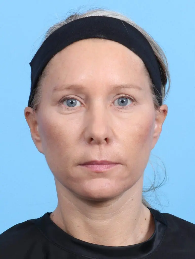 Eyelid Surgery - Case 23108 - After