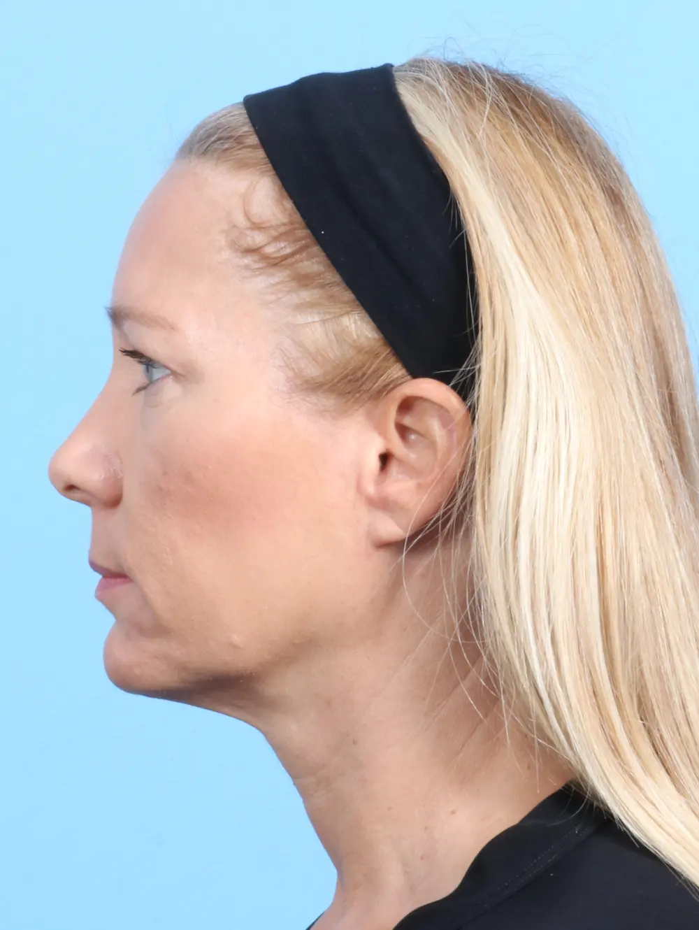 Eyelid Surgery Patient Photo - Case 23108 - before view-2