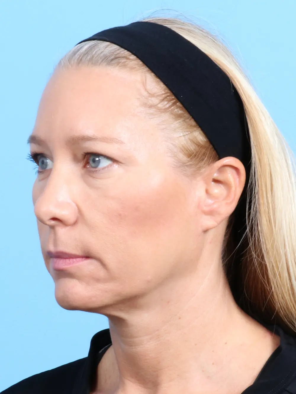 Eyelid Surgery Patient Photo - Case 23108 - before view-1