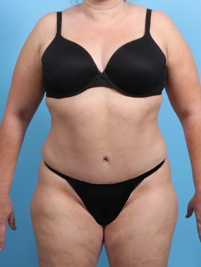 Tummy Tuck - Case 23116 - After