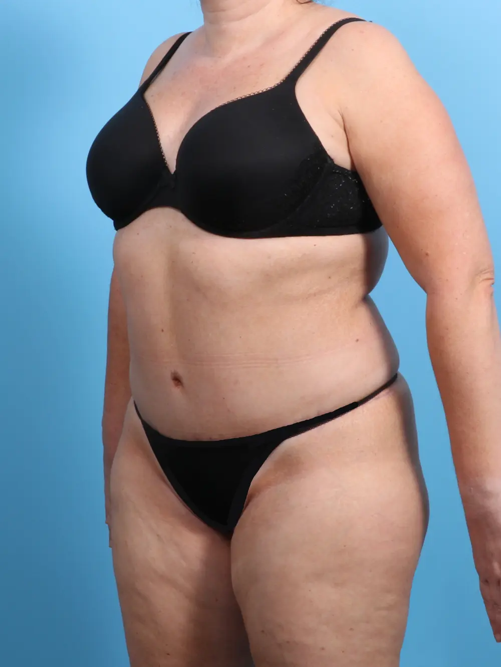 Tummy Tuck Patient Photo - Case 23116 - after view-1