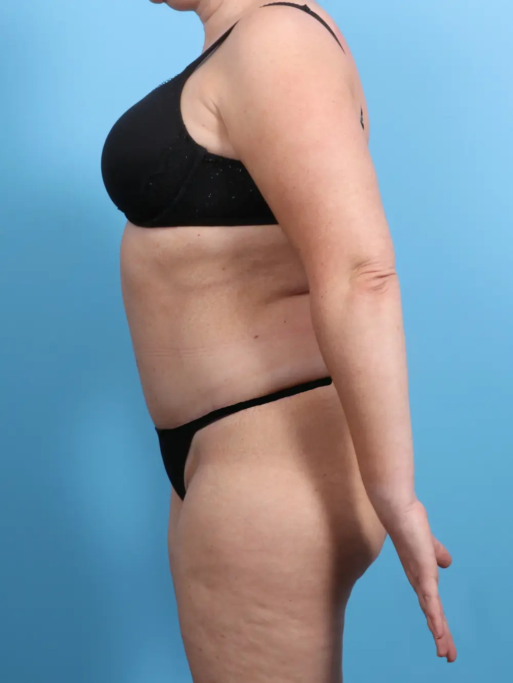 Tummy Tuck Patient Photo - Case 23116 - after view-2