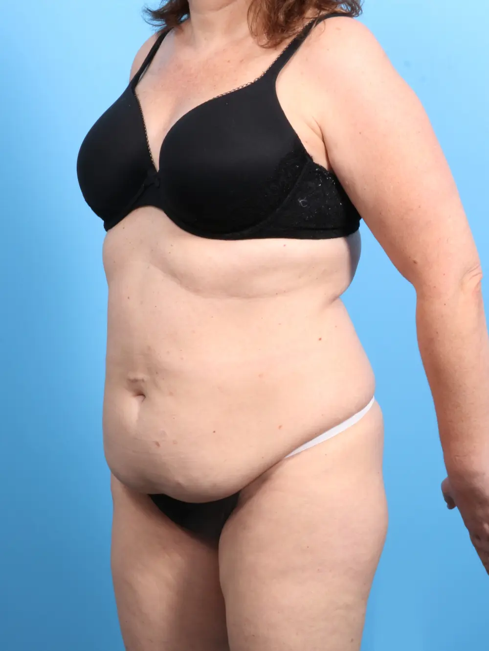 Tummy Tuck Patient Photo - Case 23116 - before view-1