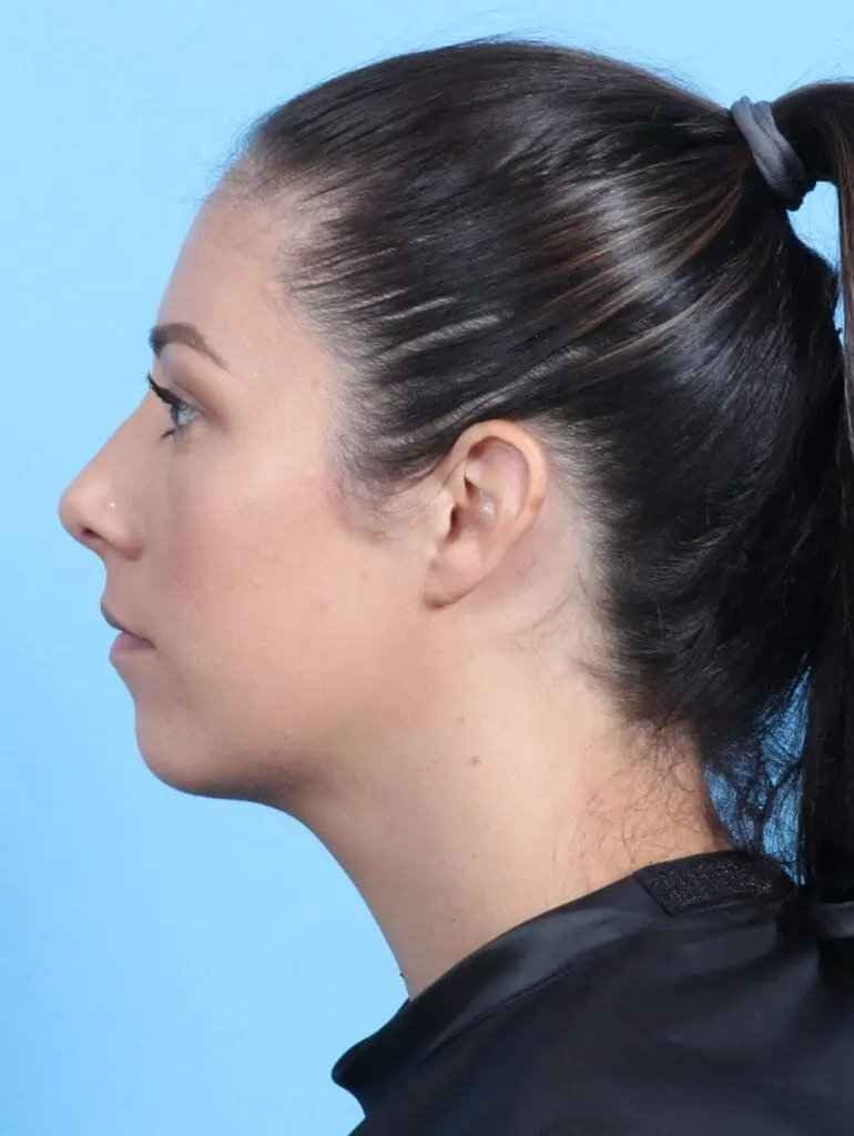 Liposuction - Case 23160 - After