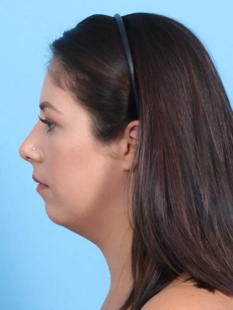 Liposuction - Case 23160 - Before