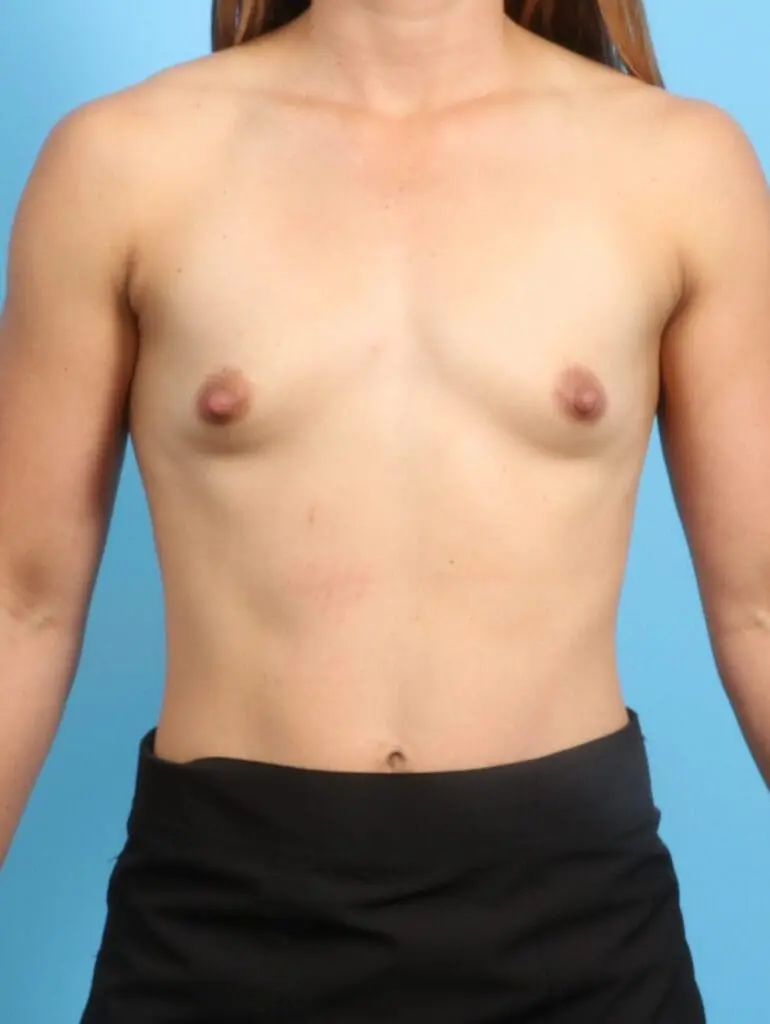 Breast Augmentation - Case 23181 - Before