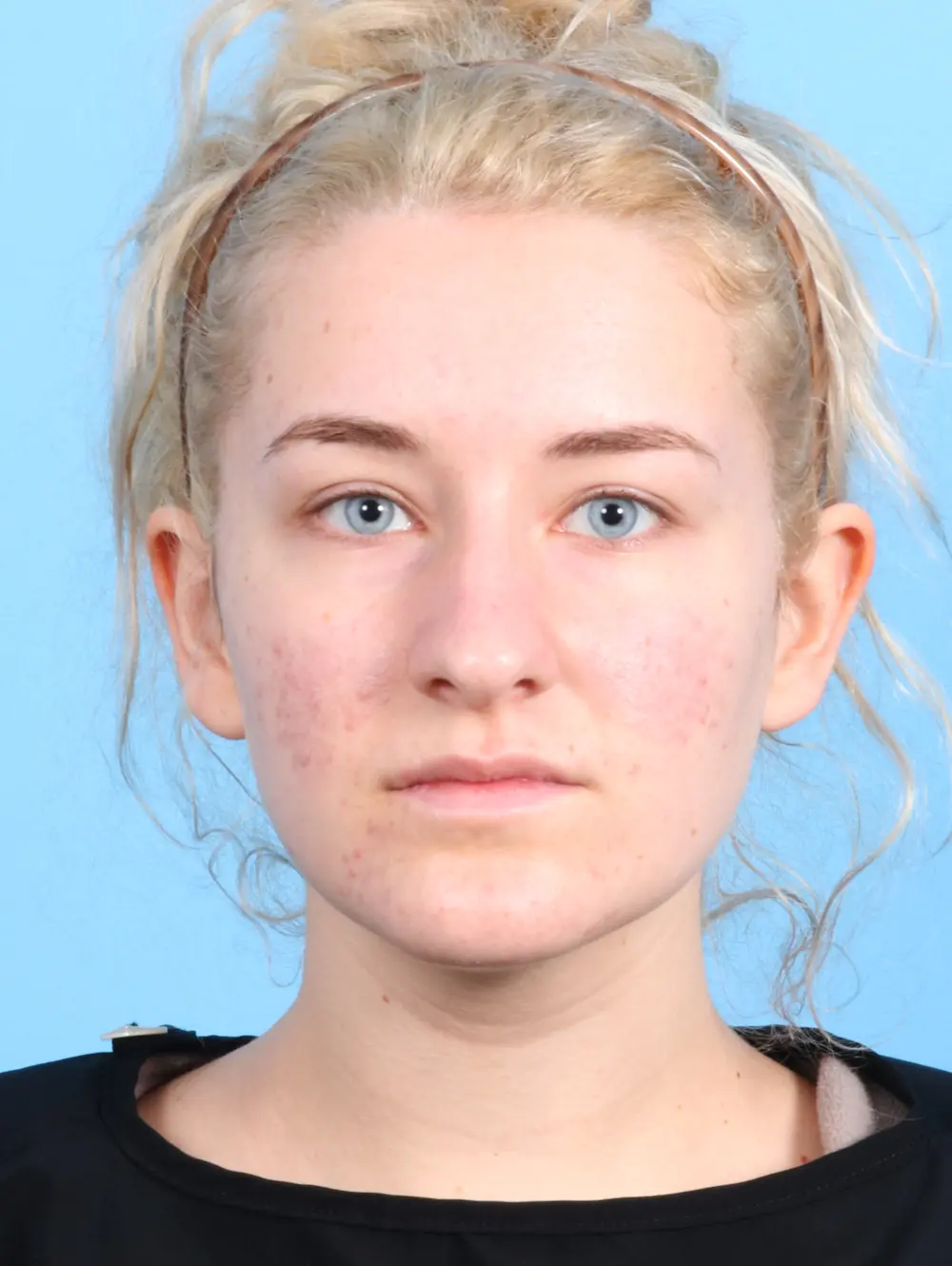 Rhinoplasty Patient Photo - Case 23266 - before view-1