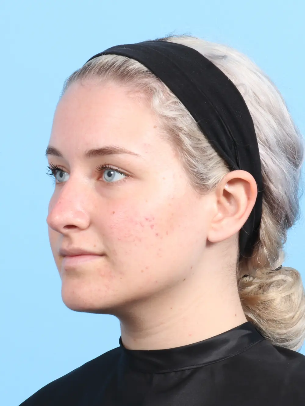 Rhinoplasty Patient Photo - Case 23266 - after view-2