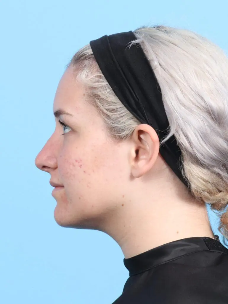 Rhinoplasty - Case 23266 - After