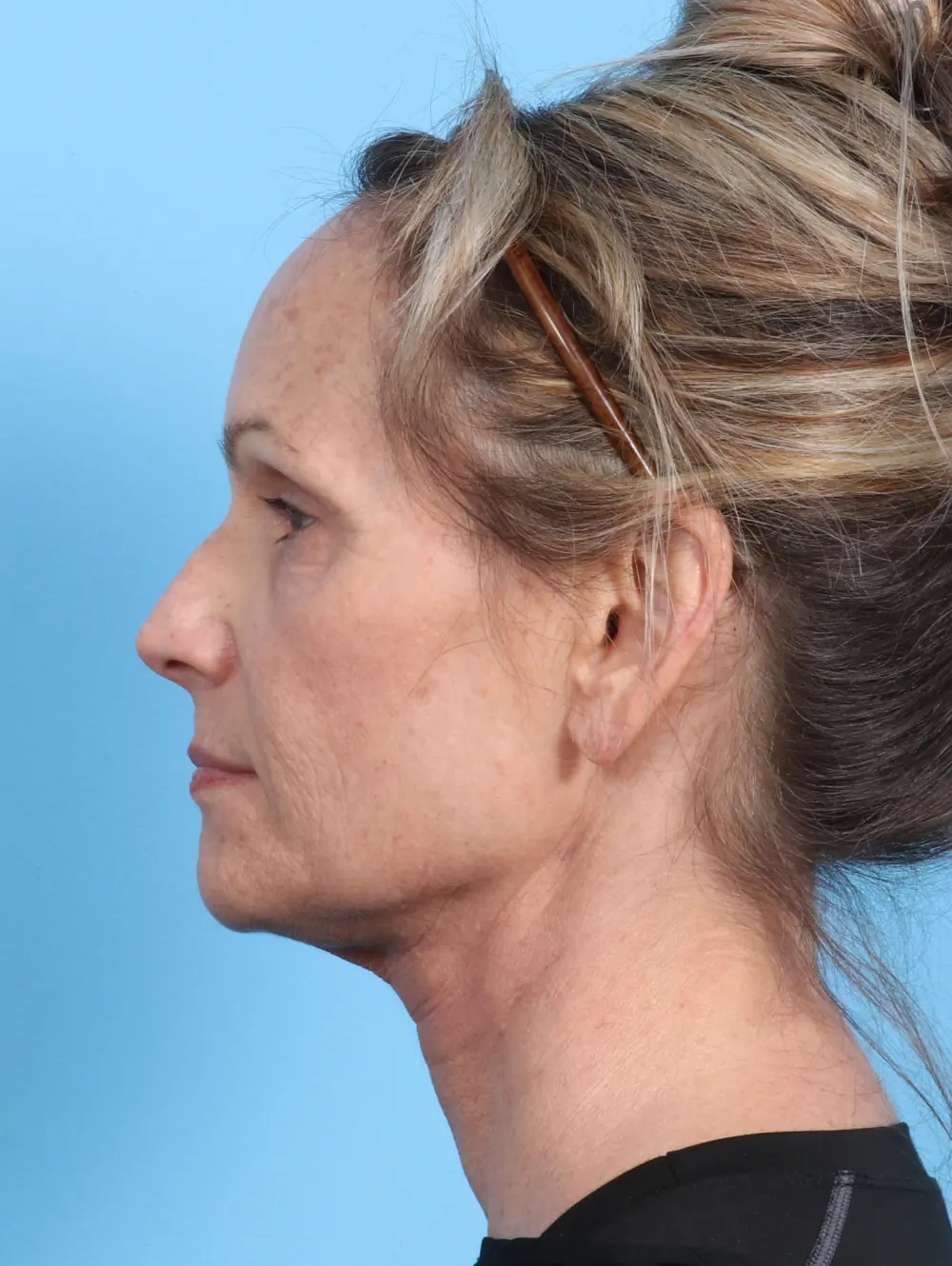 Eyelid Surgery Patient Photo - Case 23350 - before view-2