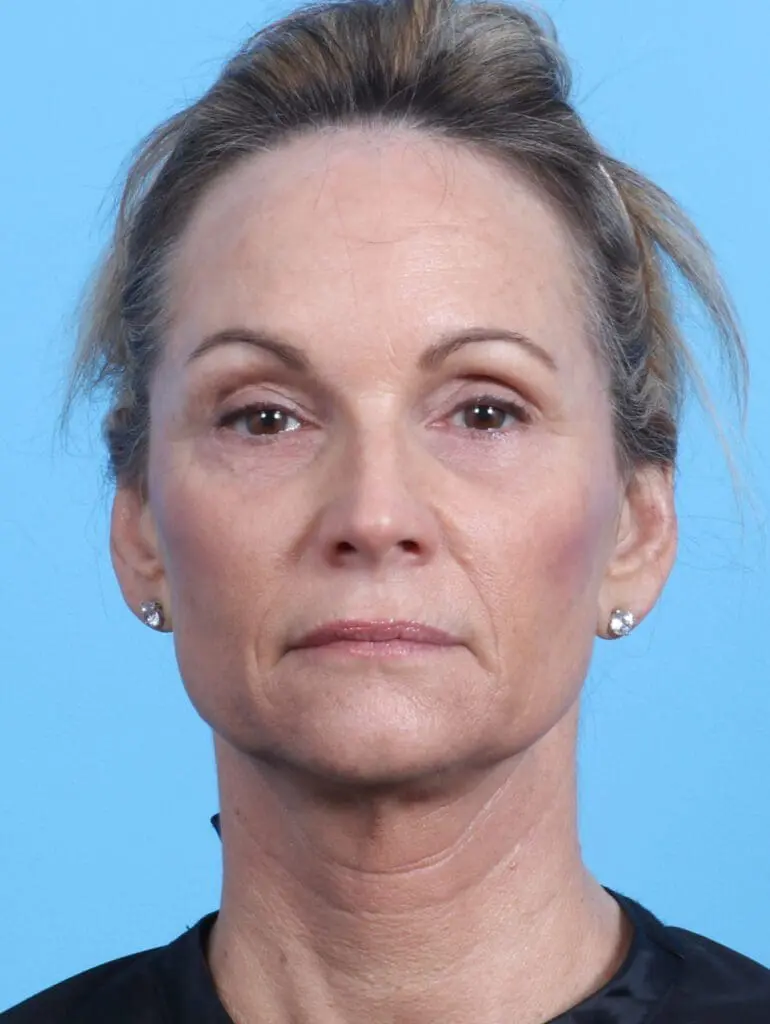 Eyelid Surgery - Case 23350 - After