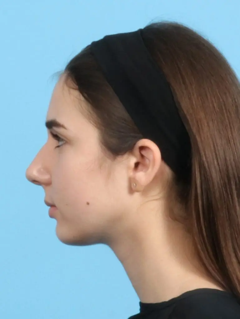 Rhinoplasty - Case 23366 - Before