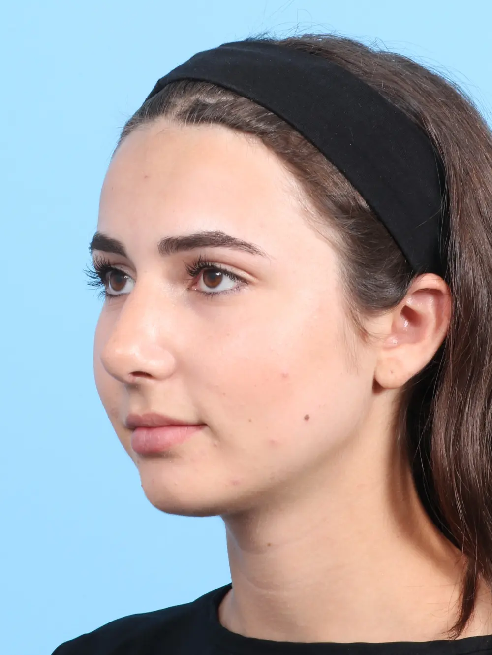 Rhinoplasty Patient Photo - Case 23366 - after view-2