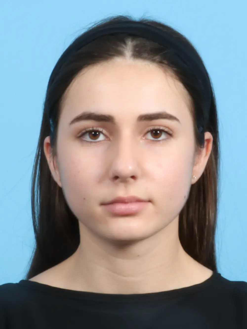 Rhinoplasty Patient Photo - Case 23366 - before view-1