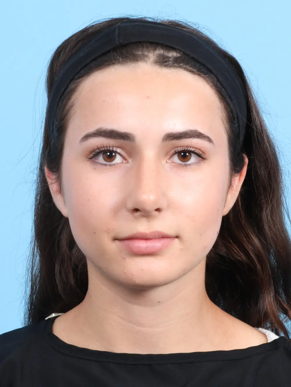 Rhinoplasty Patient Photo - Case 23366 - after view-1